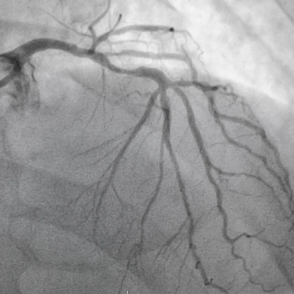 Coronary angiography