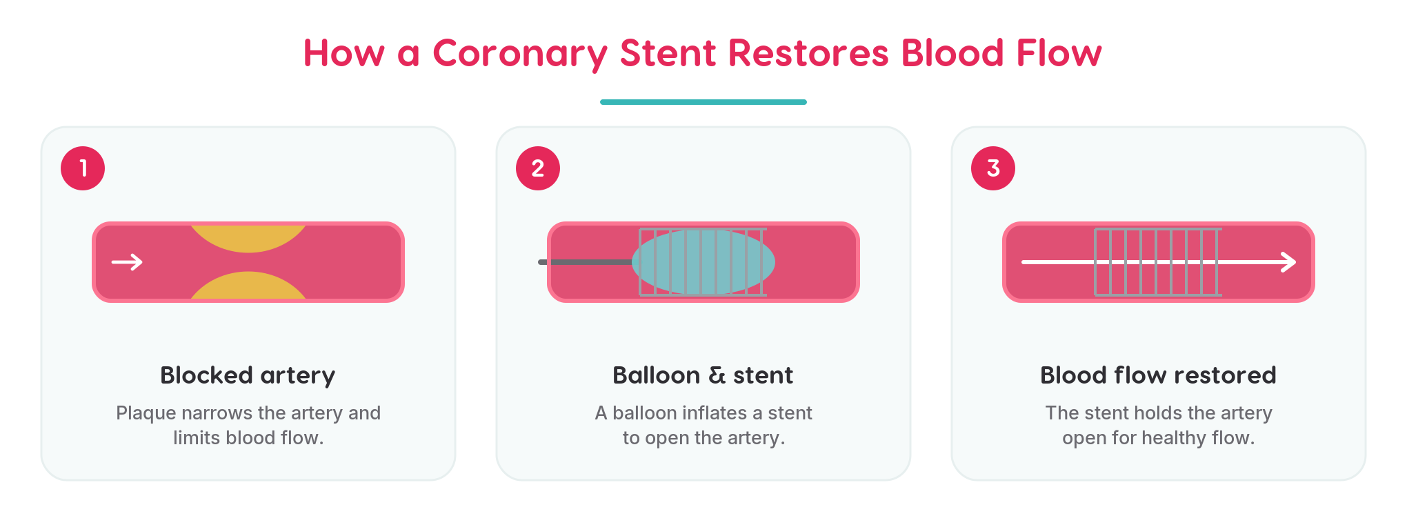 Three-step diagram of how a coronary stent restores blood flow: a coronary artery narrowed by plaque, a balloon inflating a stent to open the artery, and normal blood flow restored through the stented artery.