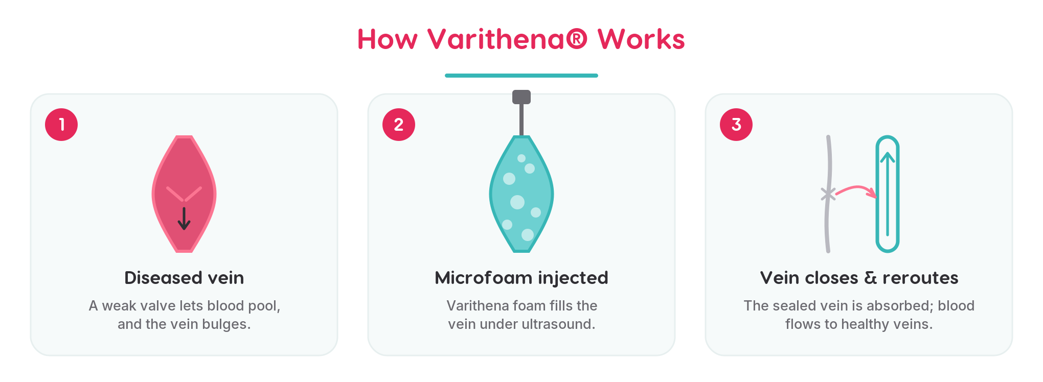 Three-step diagram of how Varithena treats varicose veins: a diseased bulging vein with a weak valve, Varithena microfoam injected under ultrasound guidance, and the vein sealing closed as blood reroutes to healthy veins.